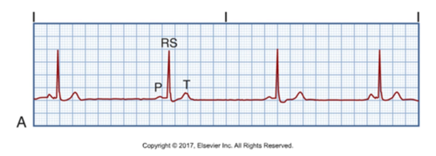 <p>Rate: &lt;60</p><p>Cause: Vagal stimulation of vagus nerve, MI, Digoxin toxicity, well-trained athlete</p><p>Manifestations: Dizziness, pallor, weakness, syncope, diaphoresis, hypotension</p><p>Treatment: Atropine (if symptoms &amp; given IV), O2, pacemaker, hold and meds that are bradycardia inducing</p>