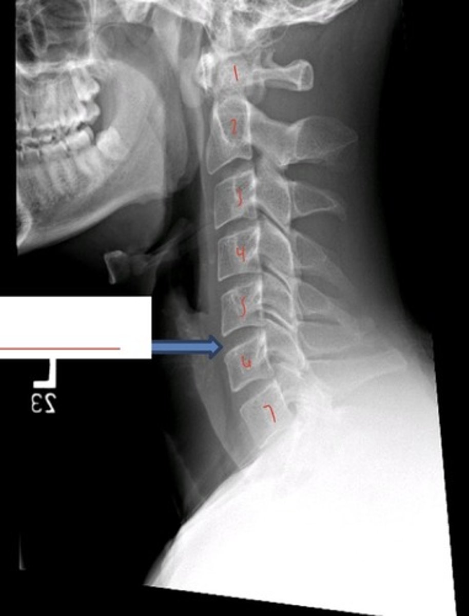 <p>what disc space is being indicated?</p>