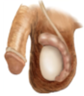 <p>Inflammation‬ of the coiled tube, called the‬ epididymis, at the back of the‬ testicle‬</p>