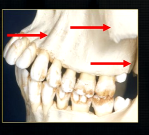 <p>the end of the maxilla can be described as, </p>