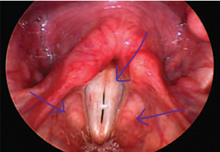 <p>• Red (erythema) swollen arytenoids (oedema)</p><p>• May be a characteristic blueish appearance to the tissues in the interarytenoid space</p><p>• Thickening of laryngeal tissues (hypertrophy - increase in muscle size) </p><p>• Swollen ventricular folds (+/- ventricular obliteration - loss of normal ventricular structure)</p><p>• Granuloma / granulation - small area of chronic inflammation in the body, characterized by a cluster of white blood cells</p><p>• Thick, sticky mucous (or perception of)</p><p>• Globus pharyngeus - the sensation of having a lump in your throat without any physical obstruction </p><p>• See Reflux Symptom Index (RSI)</p><p></p>