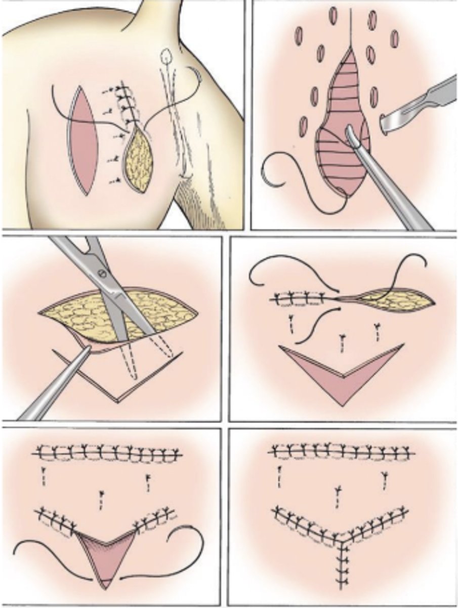 <p>- Tension relieving suture patterns</p><p>- Pre-stretching</p><p>- Undermine the wound margins to create more "stretch"</p><p>- Close along the skin tension lines</p><p>- Use SQ sutures in SA</p><p>- Stent suture</p><p>- Tension relieving surgical techniques (advancement flaps, rotation flaps, relaxing incisions)</p>