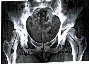 <p>A short lever arm of the abductor force, such as in coxa valga, results in a somewhat __________ joint reaction force.</p><p>a. Increased</p><p>b. Decreased</p>