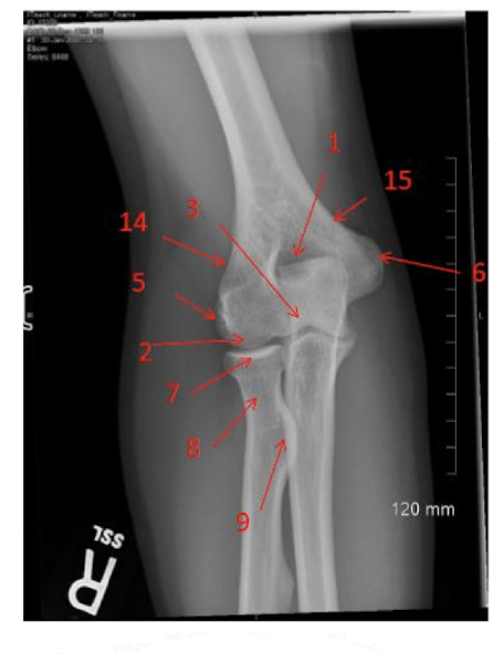 <p>Label the Upper Extremity in the photo provided.</p>