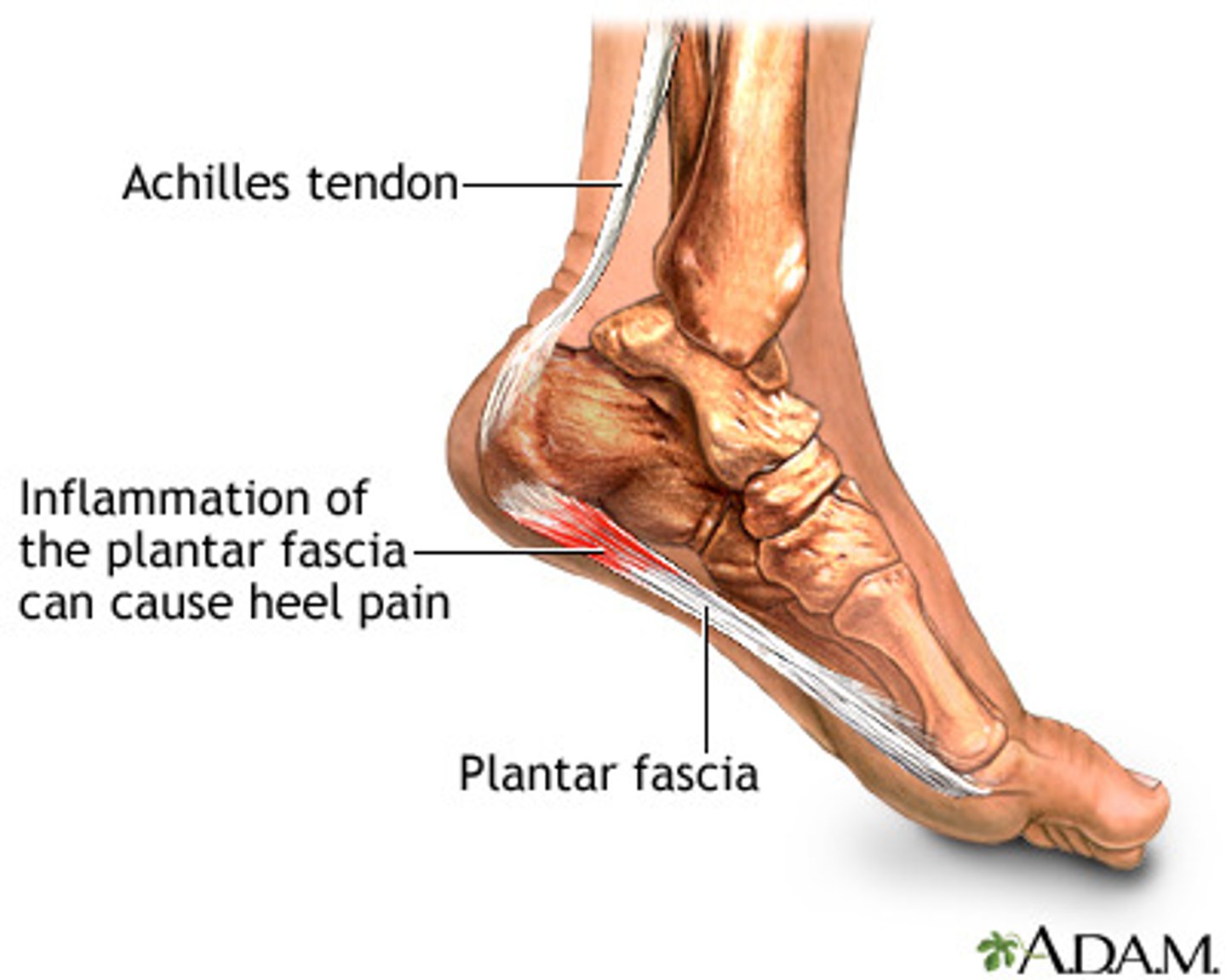 <p>Pain/inflammation under the calcaneus; worsens in the morning and with dorsiflexion</p>