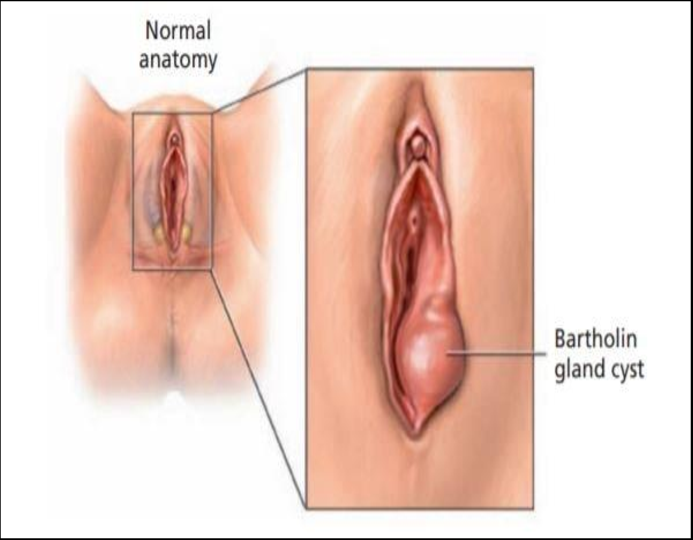 <p>Female (bart-in.gla)</p>