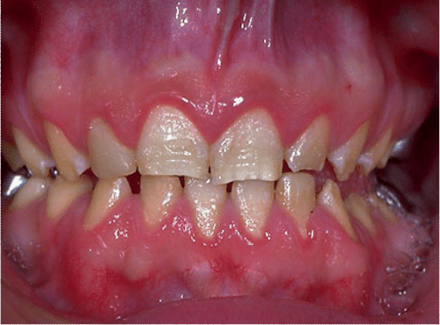 <p>1. The tooth enamel does not develop to a normal thickness</p><p>2. Autosomal dominant and autosomal recessive</p>