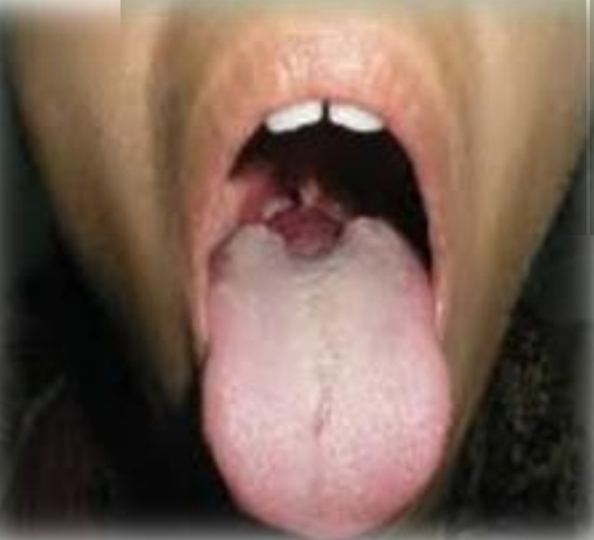 <p>Nodular mass with smooth pink or red surface. Potential suffering from dysphagia, dysphonia or dyspnea</p><p class="has-focus">Second decade - symptoms developed during puberty or pregnancy</p><p class="has-focus">Female prediliction</p><p class="has-focus"><strong>Found on:</strong></p><p class="has-focus">Midline base of tongue</p><p class="has-focus">Thyroglossal duct cys (in neck midline)</p>