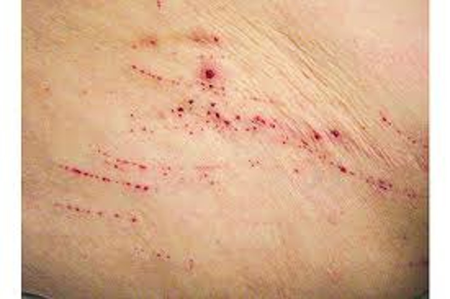 <p>Excoriation (secondary lesion)</p>