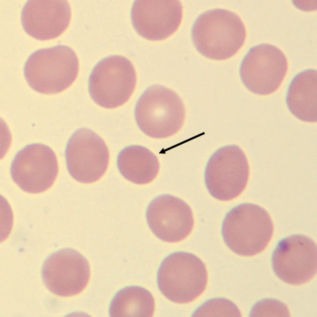 <p>What characteristic describes this erythrocyte?</p>