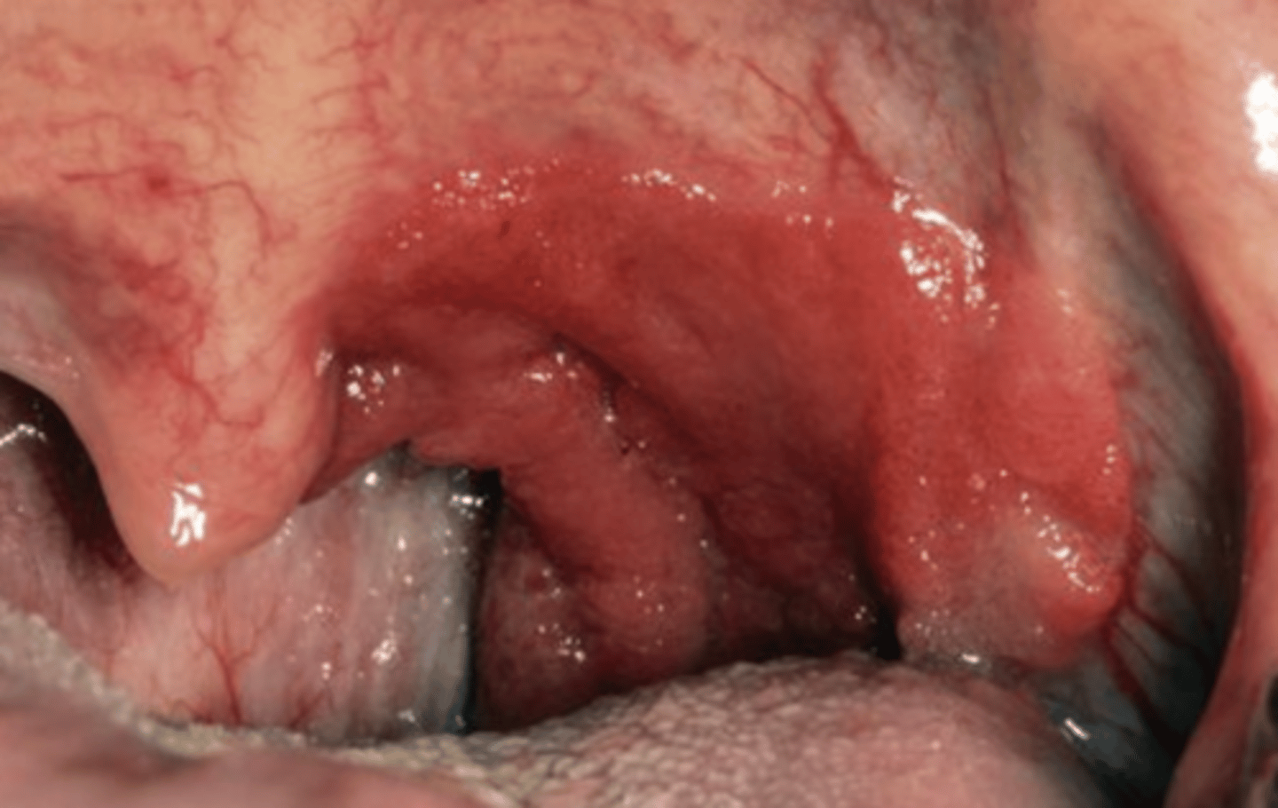<p>Location: tonsillar region, base of tongue, soft palate, posterior pharyngeal wall (hard to see)</p><p>Often unrecognized for long periods of time</p><p>80% are late stage diagnoses </p>