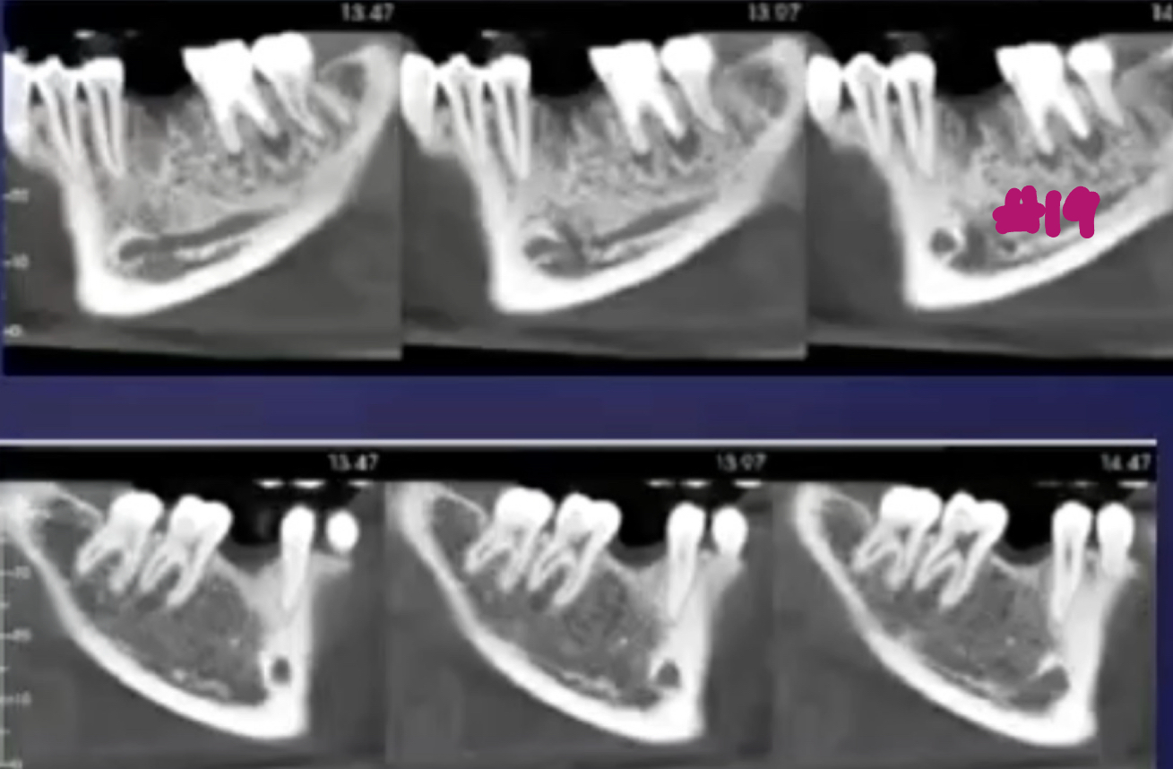 <p>what are the alterations in trabecular bone pattern and marrow spaces of periapical inflammatory diseases?</p>