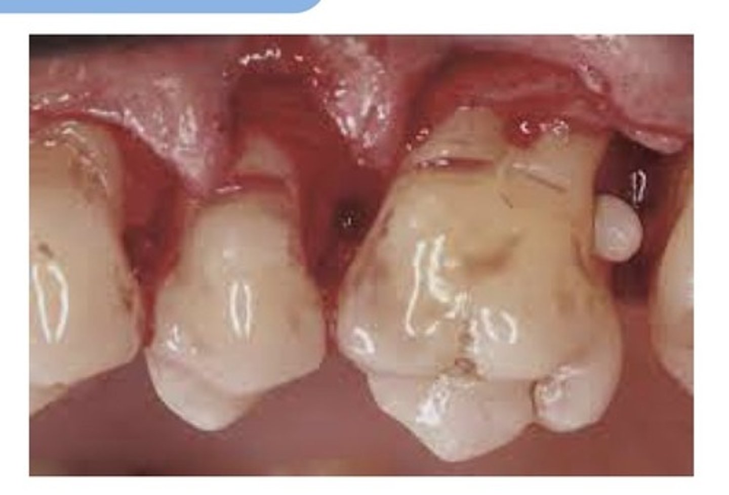 <p>A small, spherical enamel projection on a root surface. Usually found on maxillary molars. Sadiographically, it appears as a small, spherical radiopacity. Removal may be necessary if periodontal problems occur in the furcation.</p>