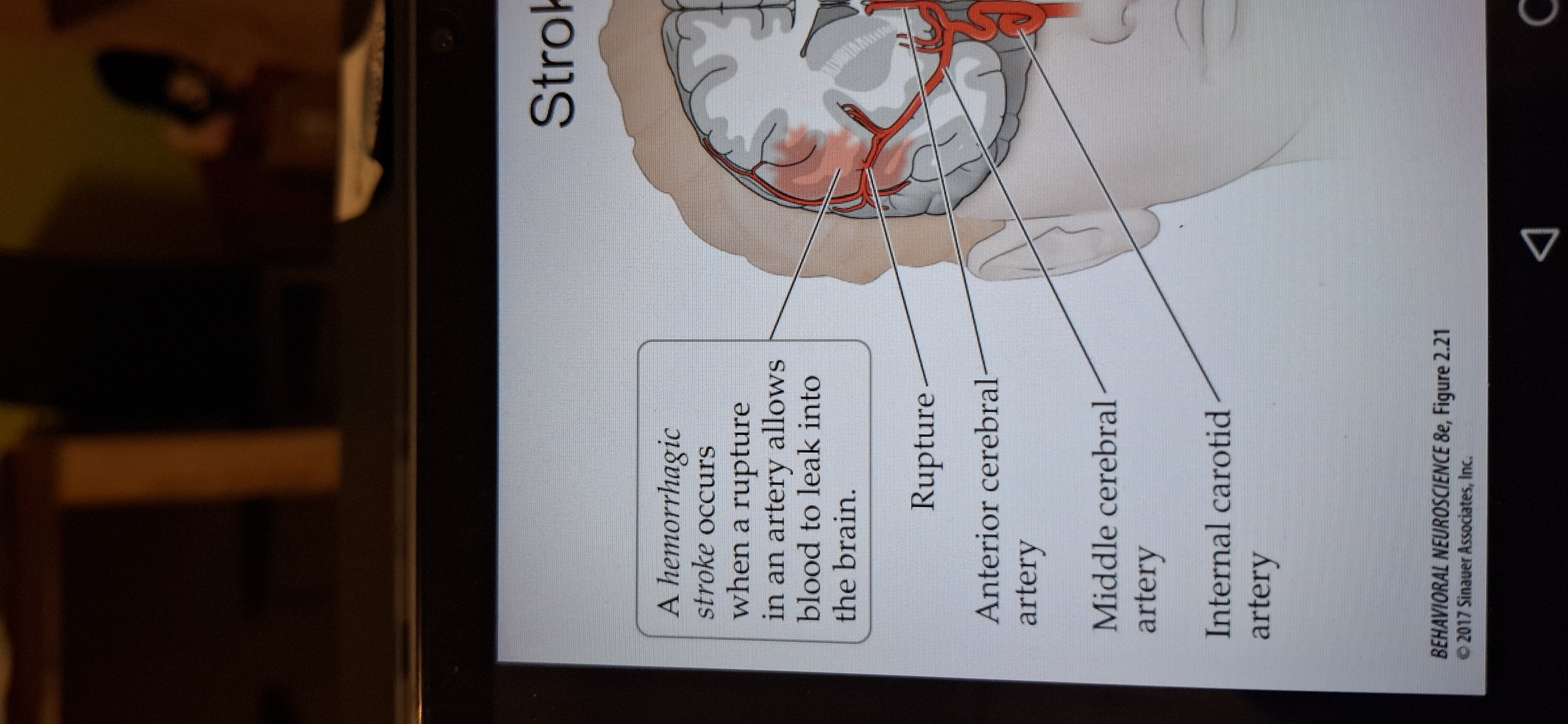 <p>When a rupture in an artery allows blood to leak into the brain (15%)</p><p class="has-focus">Mass lesions can displace nervous system structures so severely that they are shifted from one compartment to another. A situation called herniation.</p>