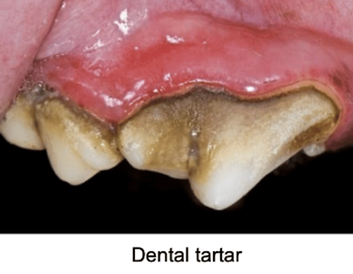 <p>- Accumulation of periodontal bacterial plaque</p><p>- Leads to gingivitis, atrophy of periodontal stroma</p><p>- Recession of gingiva</p><p>- Loss of tooth attachment, loosening</p><p>Infection and osteomyelitis (in severe case)</p>