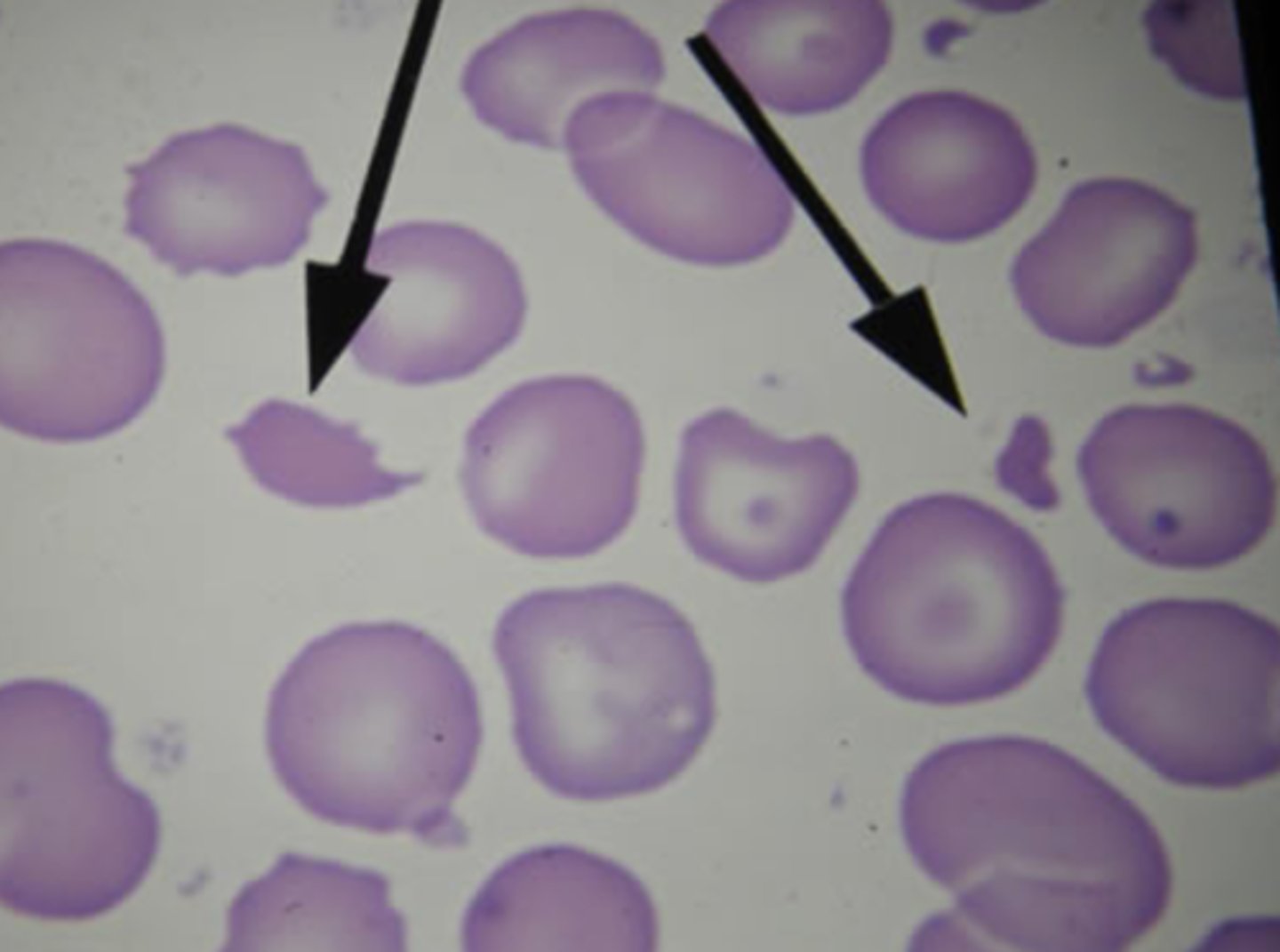 <p>destruction of red blood cells</p>