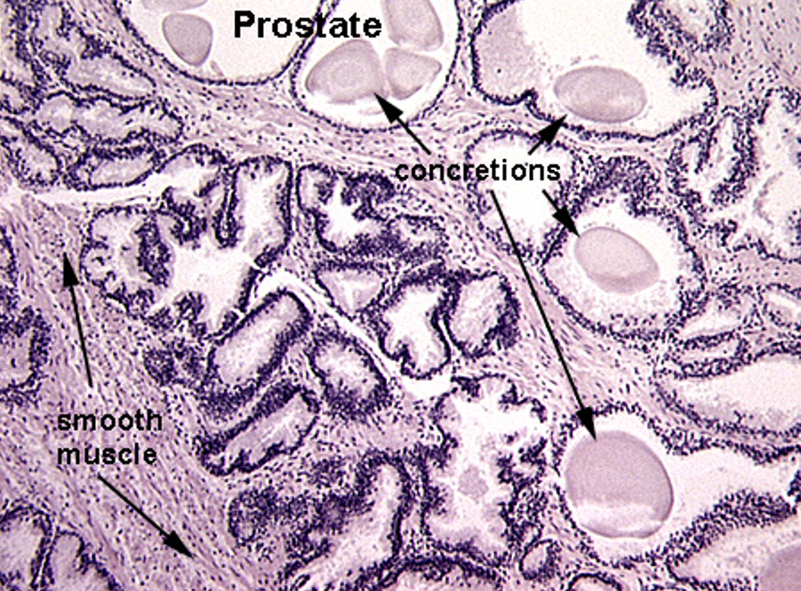 <p><strong>Glycoprotein concretions (clumps) </strong>found in <strong>that commonly form inside the prostate glands</strong></p>