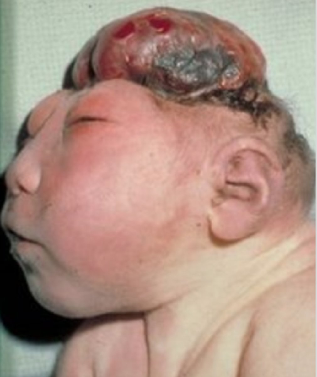 <p>Skull defect through which various tissues protrude</p>