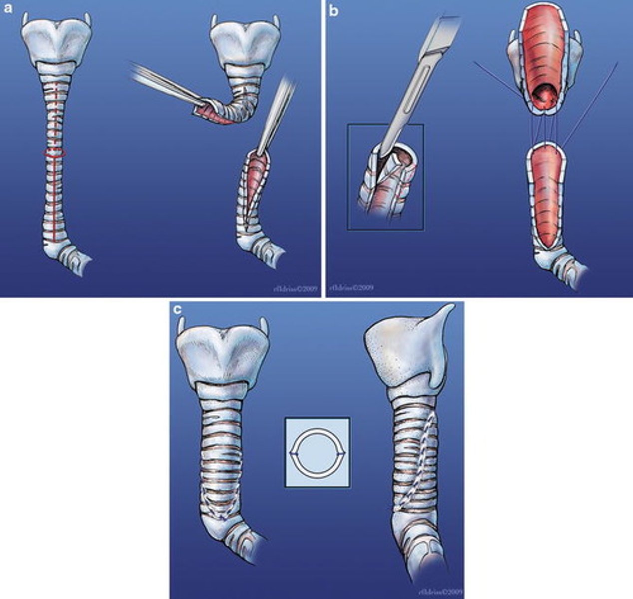 <p>for longer segment stenosis. smaller segments can just do resection and primary anastomosis.</p>