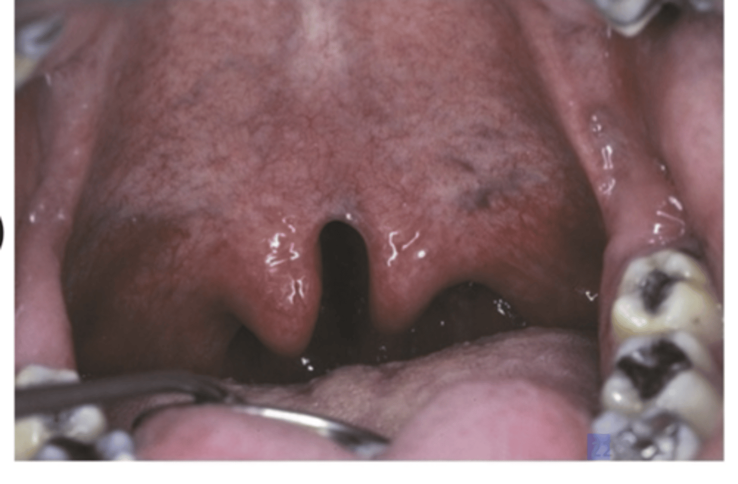 <p>Cleft uvula has a higher prevalence than what? what race is it seen higher and lower in? </p>