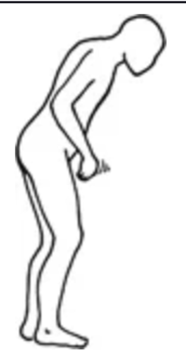 <p>- An abnormal gait in which the person hesitates to walk and has difficulty stopping suddenly</p><p>- Can be caused by parkinsonism</p>