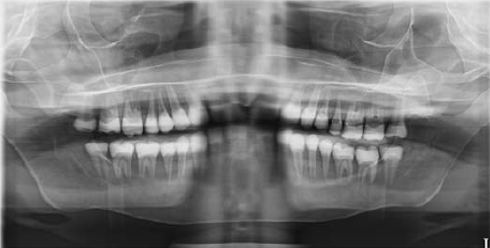 <p><span><span>·</span></span><span style="font-family: "Times New Roman"; line-height: normal; font-size: 7pt;"><span> </span></span><span><span>A “reverse smile line” is apparent on the image</span></span></p>