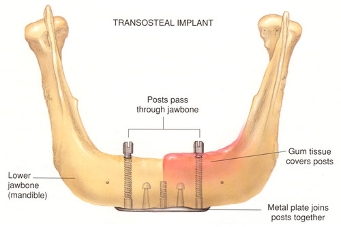 <p>- Large plate stabilised on the inferior border of the mandibular bone w/ posts extending through the gingiva;</p><p>- Used to anchor prostheses in diff situations</p>