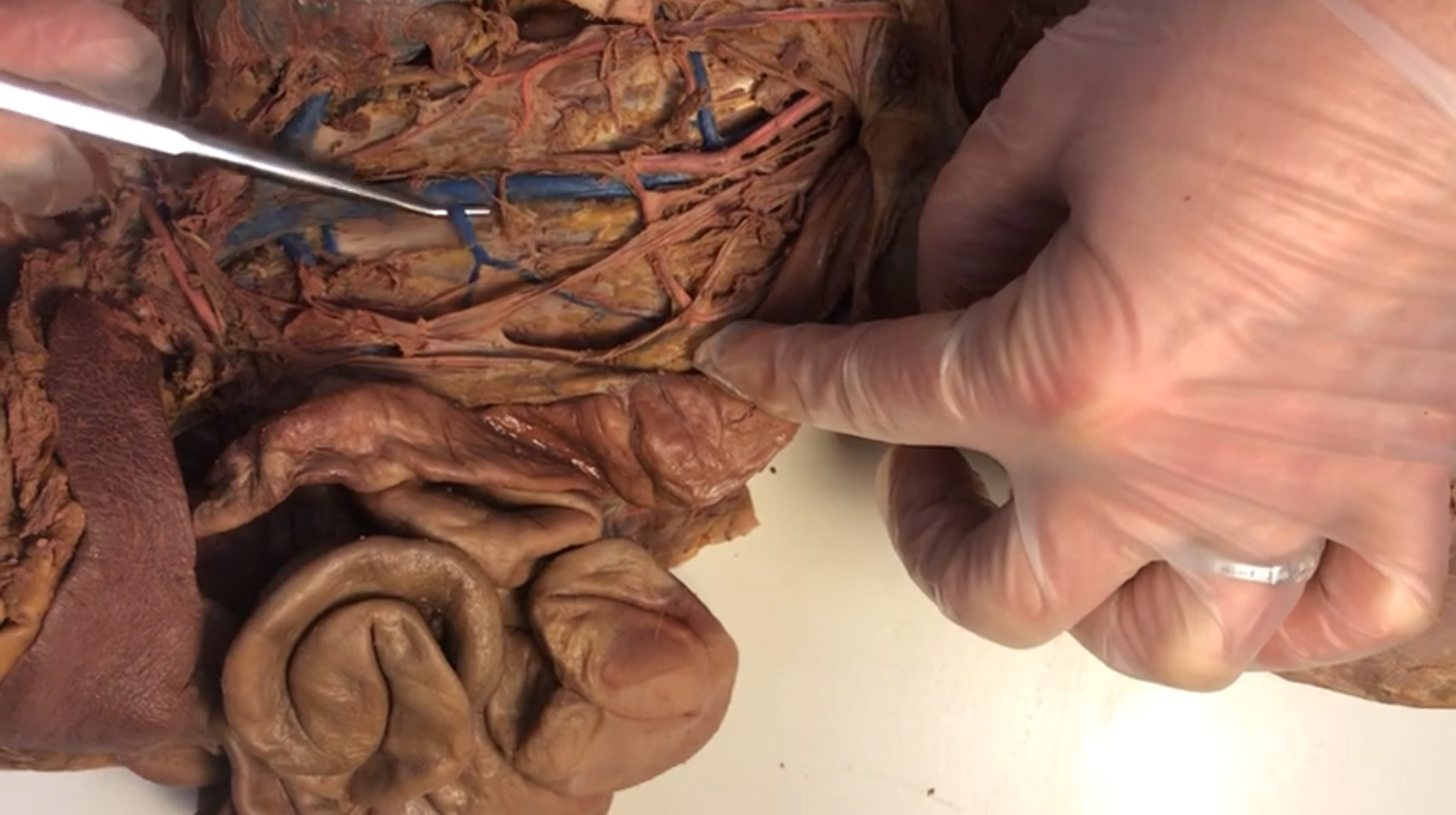 <p>What vein is this</p>