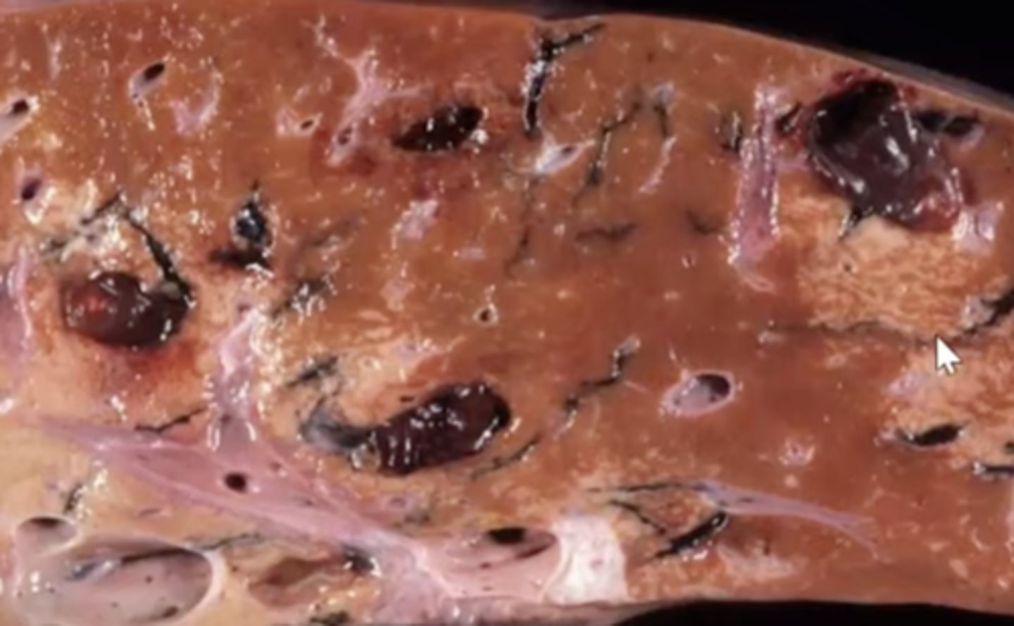 <p>What has caused this gross appearance of this liver?</p>