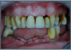 <ul><li><p>Severe/chronic gum disease</p></li><li><p> Bone destruction and tooth loss</p></li><li><p> Gums are inflamed and bleed easily</p></li></ul>