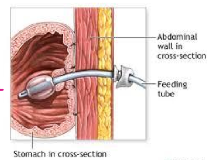<p>a form of enteral administration in which: </p><ul><li><p>a tube is inserted through the abdomen into the stomach </p></li><li><p>used to administer nutrition and medications </p></li><li><p>balloon is inflated so it doesn’t fall out </p></li></ul><p></p>