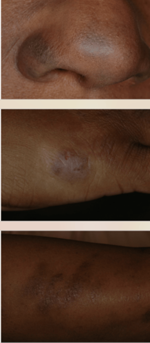 <p>Skin hyperpigmentation can be caused by what?</p>