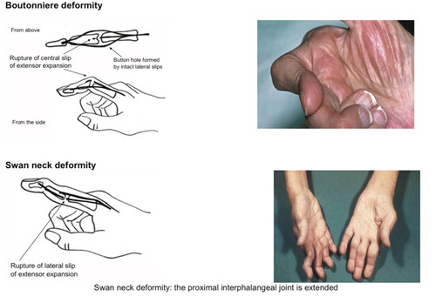 <p>Palmar erythema</p><p>Wasting of thenar eminence- carpal tunnel syndrome</p><p>Fixed flexion contracture</p><p>Specific abnormalities- swan neck, button hole, z thumb</p><p>Due to "rheumatoid tenosynovitis"</p>