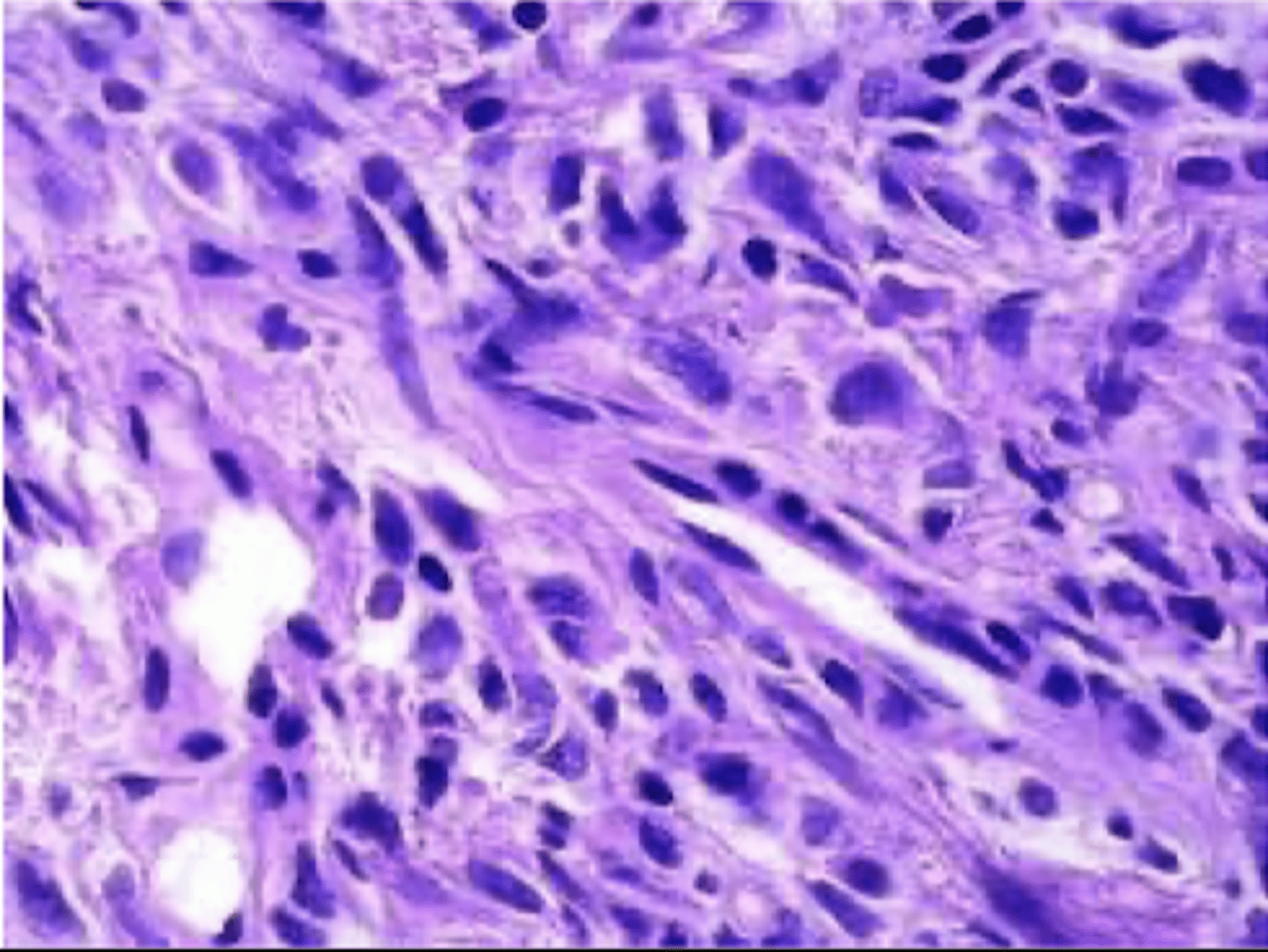 <p>arises from pericytes (myofibroblast like cells surrounding capillaries and venules)</p><p>rare</p>