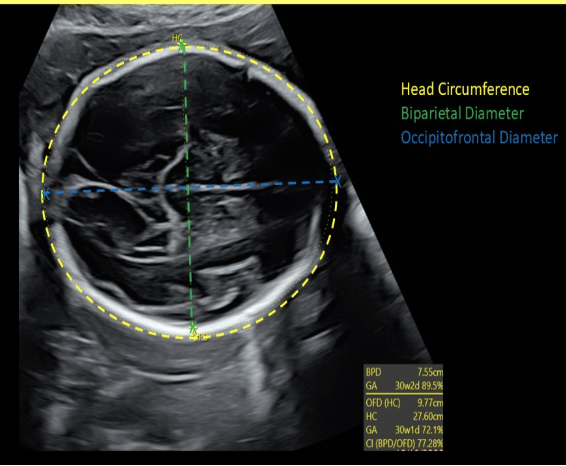 <p>the OFD of the skull is measured from ___ edge of the skull to the ___ edge of the skull</p><p>.<br>a) inner, outer</p><p>b) outer, inner</p><p>c) inner, inner</p><p>d) outer, outer</p>