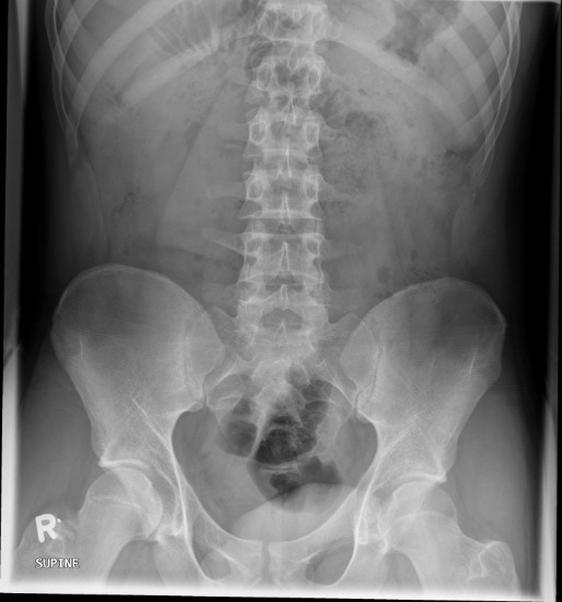 <p>What phase of respiration has been captured for this projection? What is seen radiographically to support the assessment?</p>