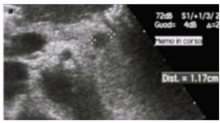<ul><li><p><span style="background-color: transparent;">70% of cases</span></p></li><li><p><span style="background-color: transparent;">Most common functioning islet cell tumor</span></p></li><li><p><span style="background-color: transparent;">Benign, small, well-encapsulated, good vascularity </span></p></li><li><p><span style="background-color: transparent;">Seen in pts with hyperinsulinism or hypoglycemia</span></p></li></ul><p></p>