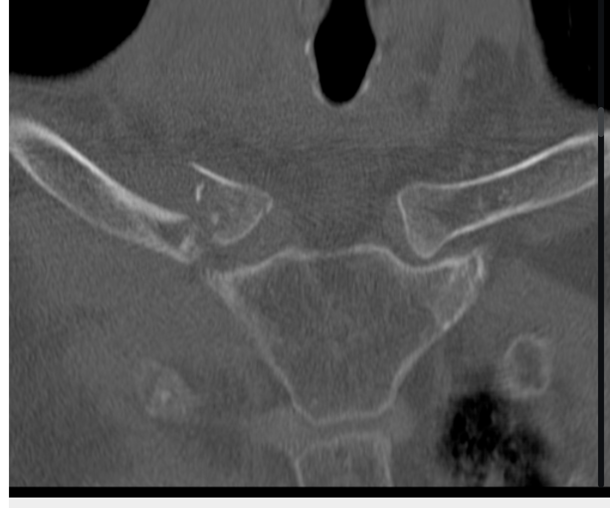 <p>Tell me about medial clavicle fractures</p>