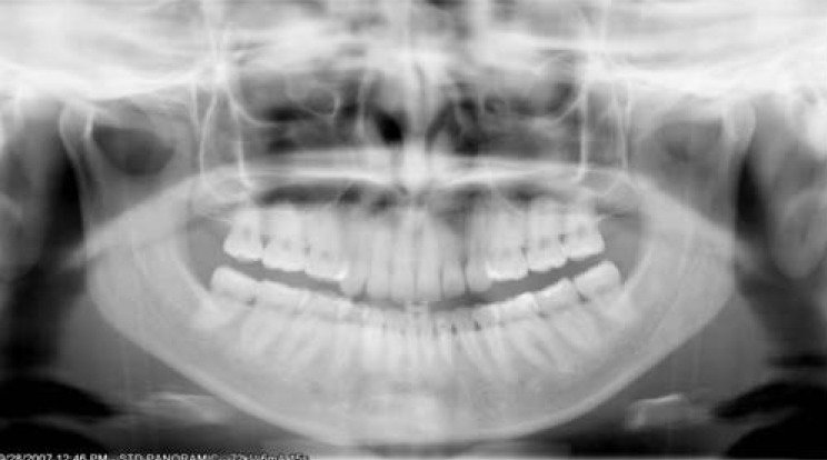 <p>A dark radiolucent band covers the apices of the maxillary teeth on the pano, making them hard to evaluate.</p>