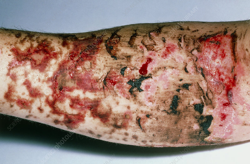 <p>3rd degree burn </p>