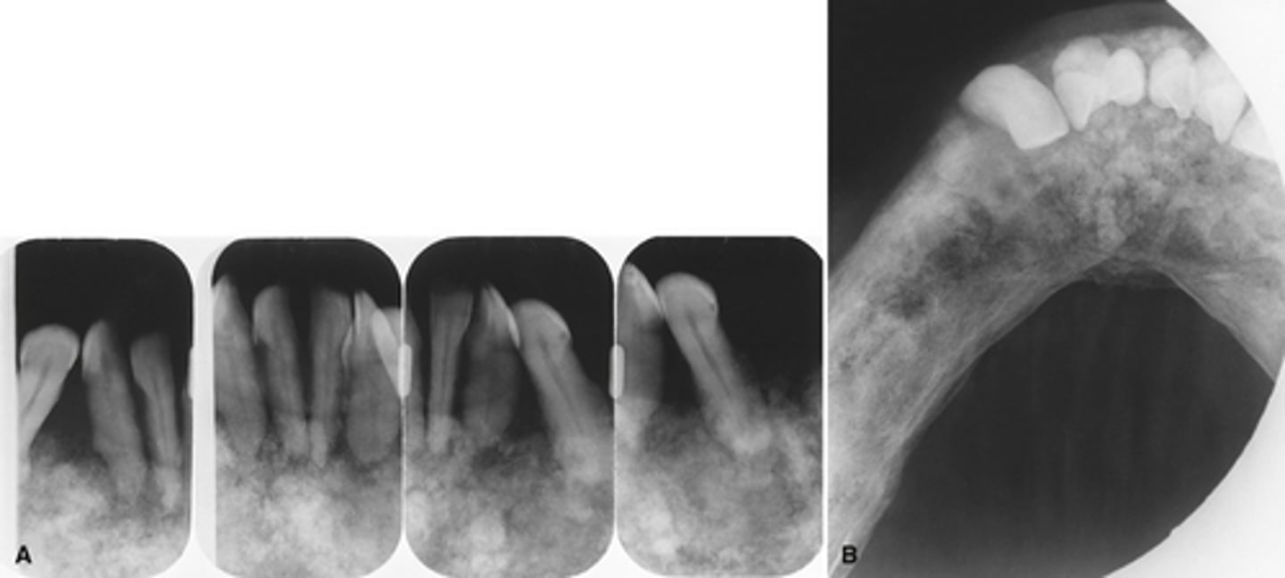 <p>The images show the intermediated stage of Paget disease accompanied by what additional diagnosis.</p>