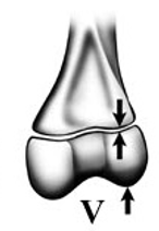 <p>Grade the Salter-Harris fracture?</p>