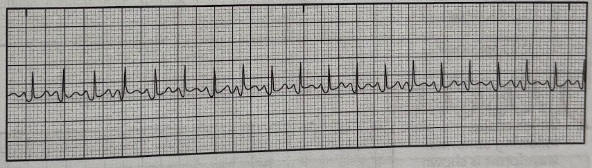 <p>Using the 6-second method, determine the patient’s heart rate from the EKG tracing.</p><p>A. 80/min</p><p>B. 90/min</p><p>C. 190/min</p><p>D. 210/min</p>