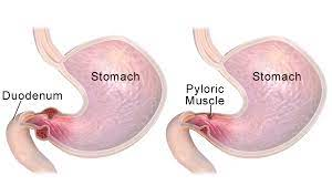 <p>Narrowing or blocking of opening between stomach and duodenum. Acquired obstruction caused by peptic ulcer disease (more often duodenal ulcers) or carcinoma. Pt becomes more distressed postprandial and later in the day. Develops anorexia and weight loss. Copious vomiting several hours after eating</p>