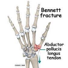 <p>-intra articular fx of 1st metacarpal</p><p><span data-name="high_voltage" data-type="emoji">⚡</span>️Ben been feeling bad because his thumb metacarpal bone is broken <span data-name="-1" data-type="emoji">👎</span></p>