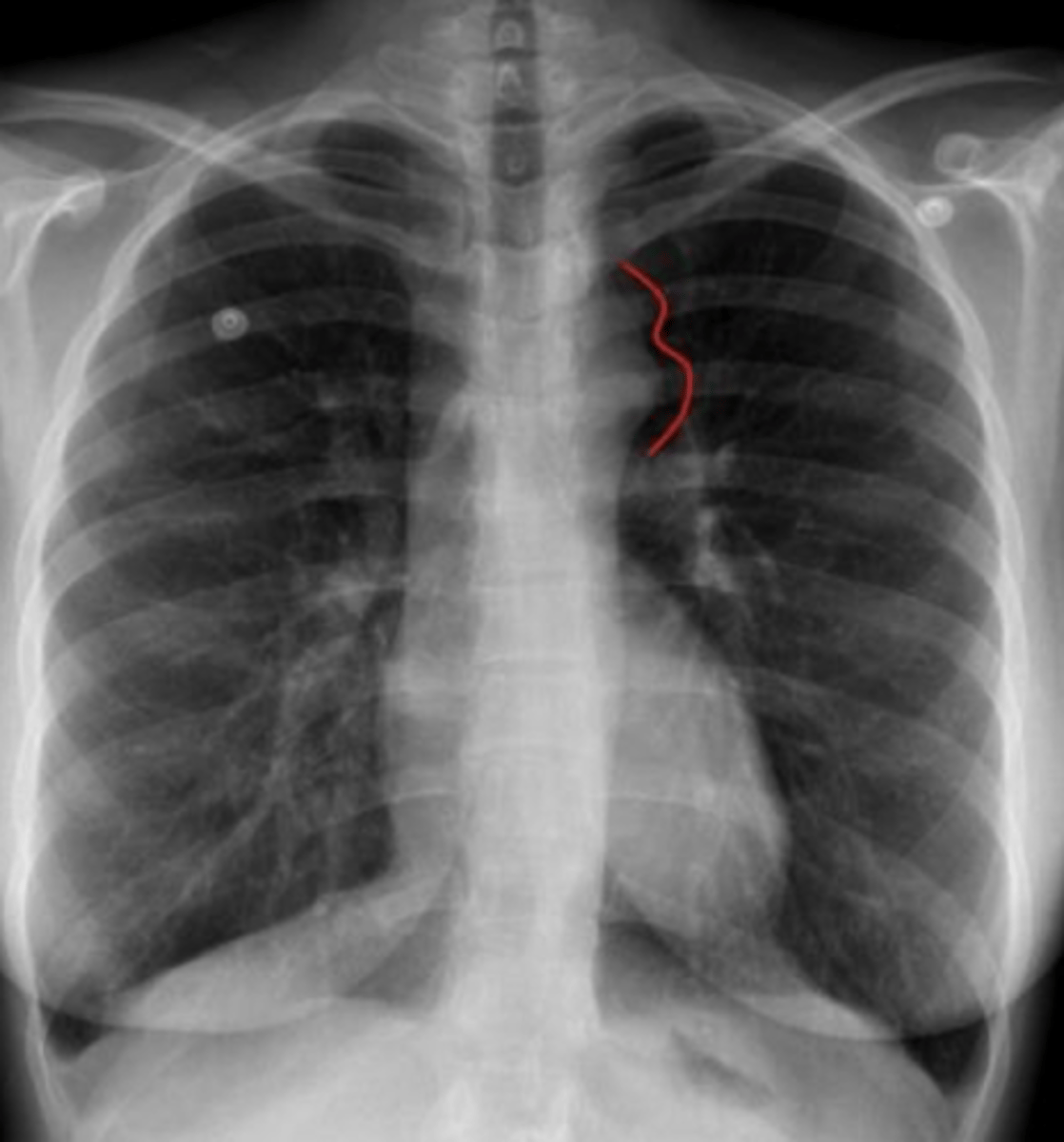 <p>coarctation of aorta</p>
