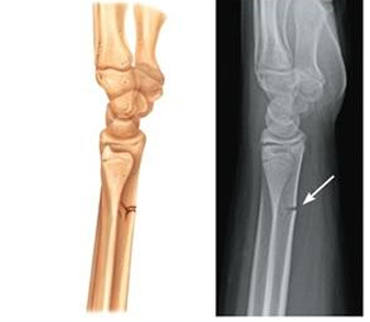 <p>Bone breaks incompletely, much in the way in the way a green twig breaks. Only one side of the shaft breaks; the other side bends. Common in children, whose bones have relatively more organic matrix and are more flexible than those of adults</p>
