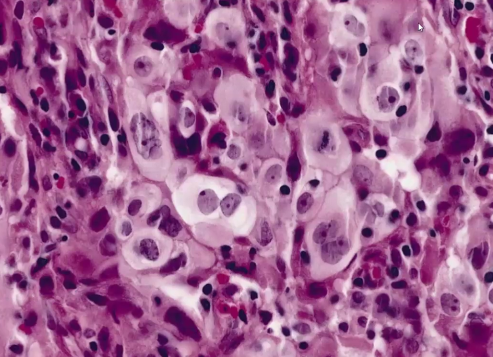 <ul><li><p>Undifferentiated epithelial tumors with no microscopic features allowing classification into any other category</p></li></ul><p></p>