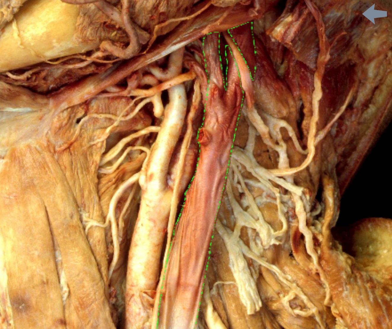 <p>Which Vein?</p>