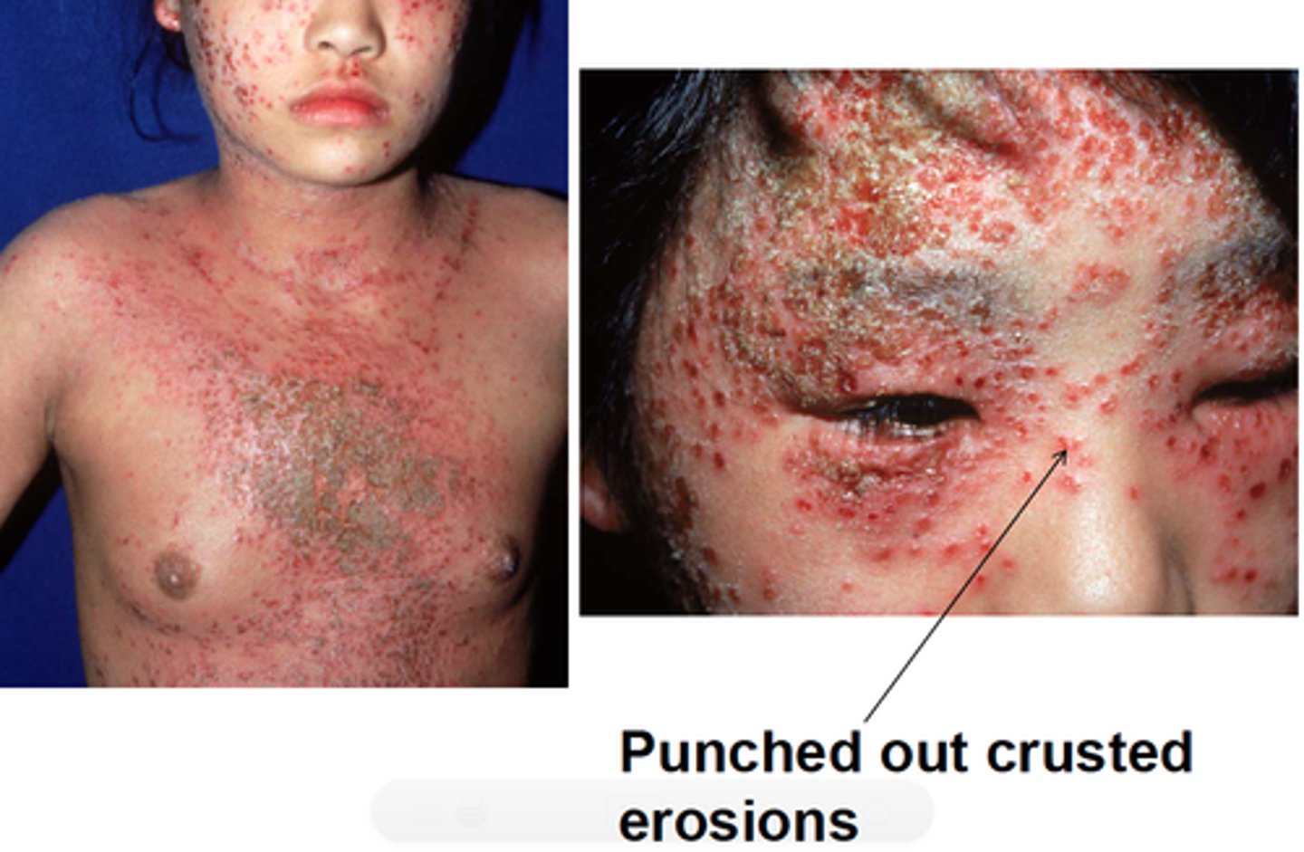 <p>Widespread HSV infection on eczematous skin - presents with clustered vesicles, punched-out erosions; treat with IV acyclovir</p>